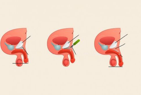 prije i nakon operacije povećanja penisa